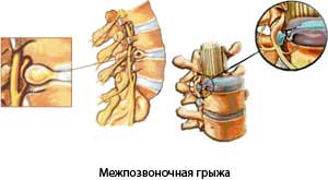 Межпозвоночная грыжа